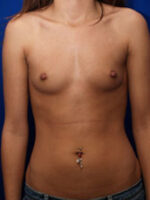 Breast Augmentation