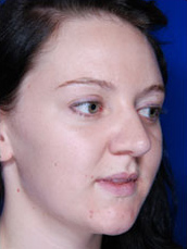 Rhinoplasty
