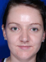 Rhinoplasty