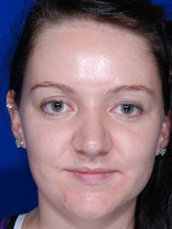 Rhinoplasty