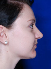 Rhinoplasty
