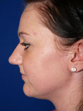 Rhinoplasty