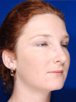 Rhinoplasty