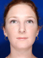 Rhinoplasty