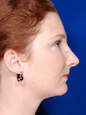 Rhinoplasty