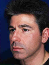 Male Rhinoplasty