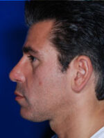 Male Rhinoplasty