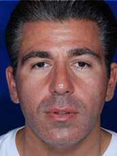 Male Rhinoplasty