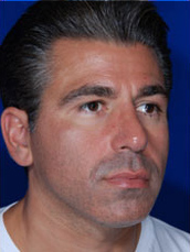 Male Rhinoplasty