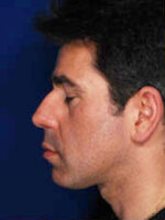 Male Rhinoplasty