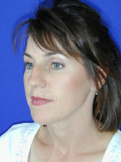 Rhinoplasty
