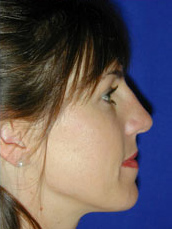 Rhinoplasty