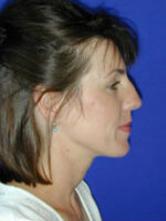 Rhinoplasty