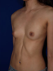 Breast Augmentation