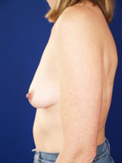 Breast Augmentation