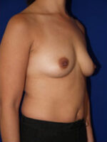 Breast Augmentation