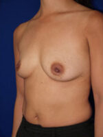 Breast Augmentation