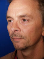 Rhinoplasty