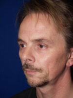 Rhinoplasty