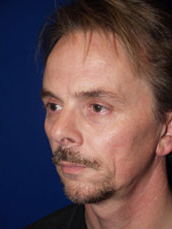 Rhinoplasty