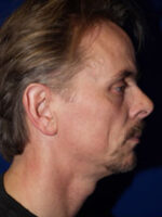 Rhinoplasty