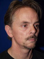 Rhinoplasty
