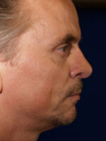 Rhinoplasty