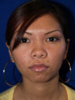 Otoplasty