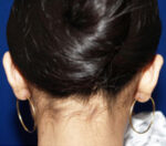 Otoplasty