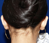 Otoplasty