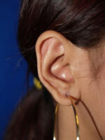 Otoplasty