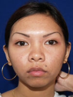 Otoplasty