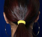 Otoplasty