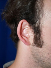 Otoplasty