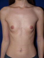 Breast Augmentation