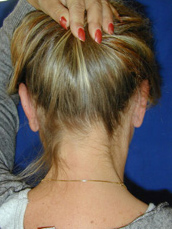 Otoplasty