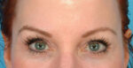 Eyebrow Transplants