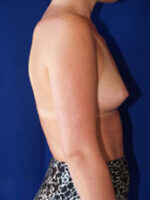 Breast Augmentation