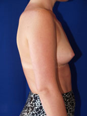 Breast Augmentation