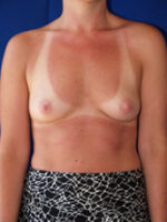 Breast Augmentation