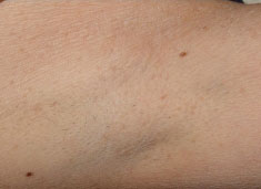 Laser Hair Removal