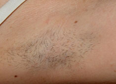 Laser Hair Removal