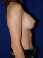 Breast Augmentation
