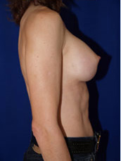 Breast Augmentation