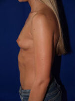 Breast Augmentation