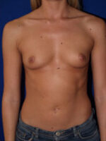 Breast Augmentation
