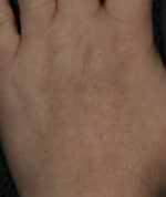 Brown Spots, Wart and Scar Removal