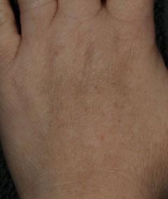 Brown Spots, Wart and Scar Removal