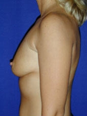 Breast Augmentation