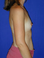 Breast Augmentation